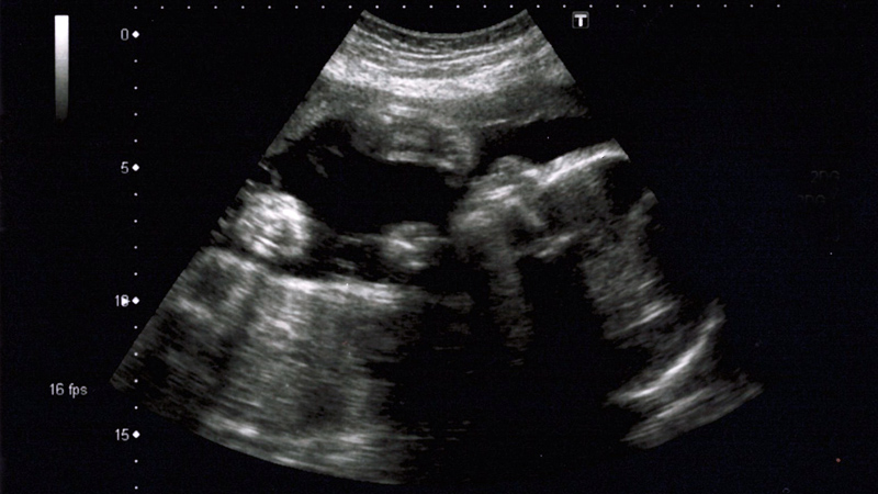 Week 26 ultrasound scan